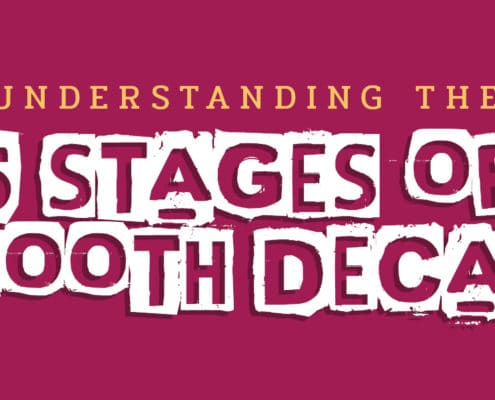 Understanding the 5 Stages of Tooth Decay